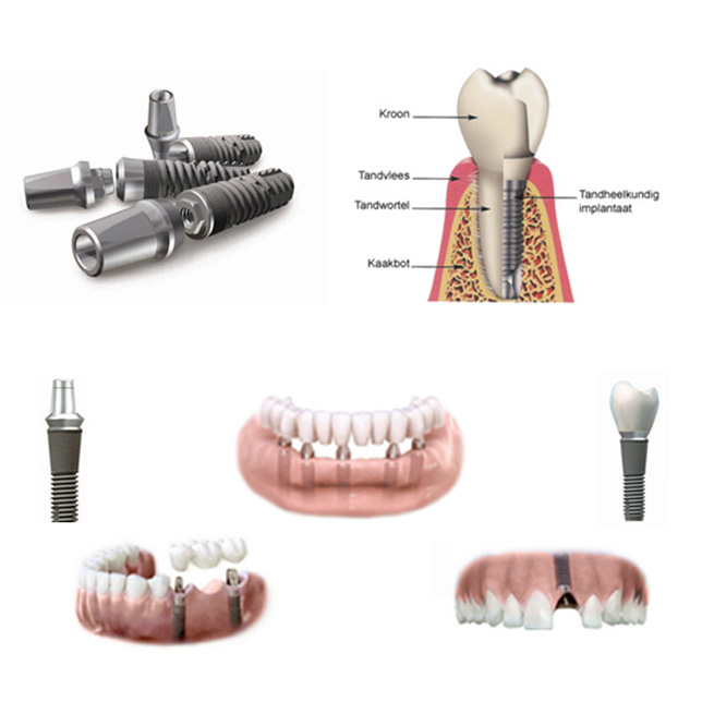 Implantologie - Tandheelkundig Centrum